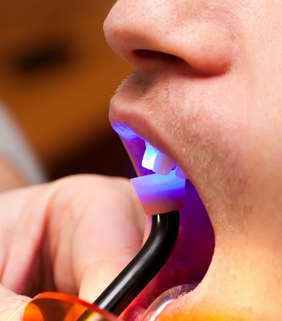 Close up of dental patient receiving cosmetic bonding on upper front tooth