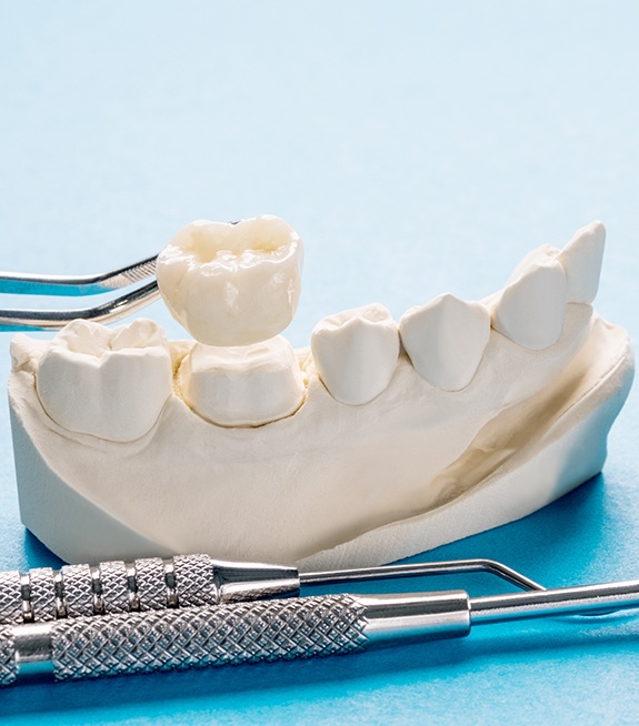 Give teeth the royal treatment with a dental crown in St. Johns, FL