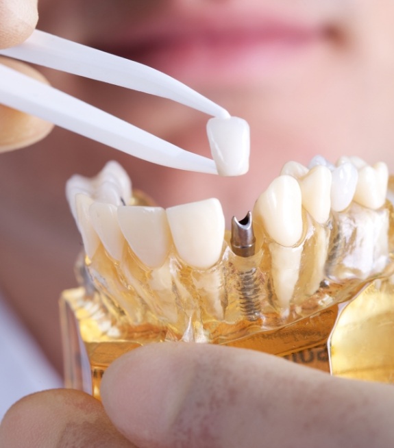 Dentist placing a crown on a model of a dental implant