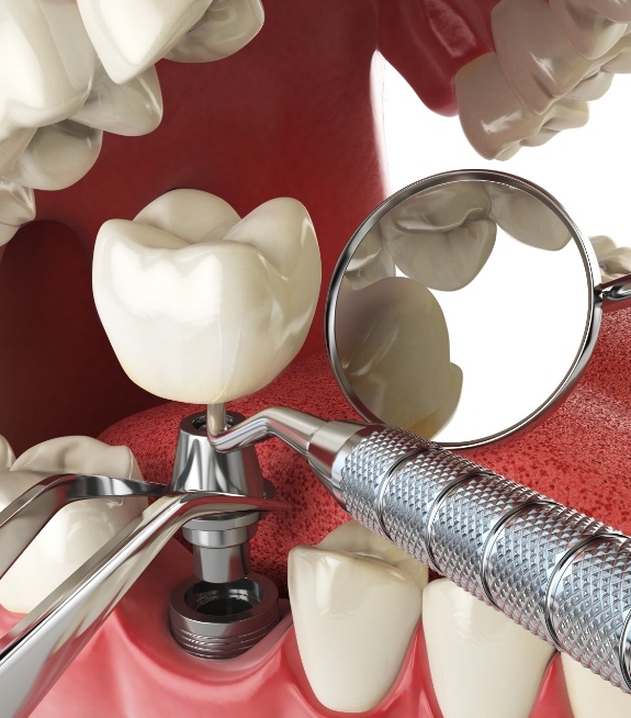 Illustration of dental crown being placed on a dental implant