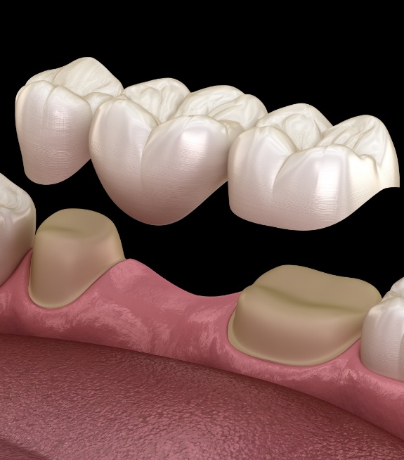 Illustrated dental bridge replacing a missing tooth