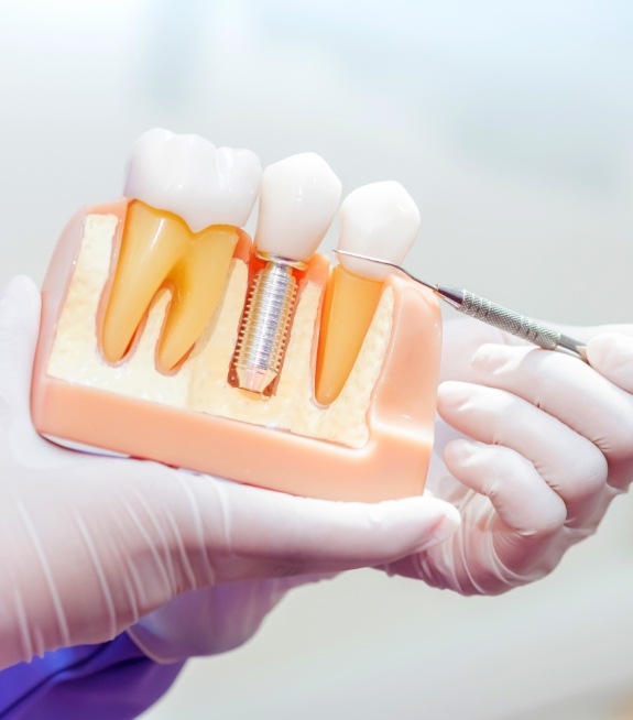 Dentist holding a model of a dental implant