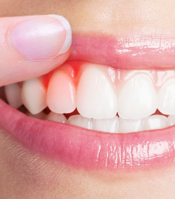 Close up of person pointing to their red gums