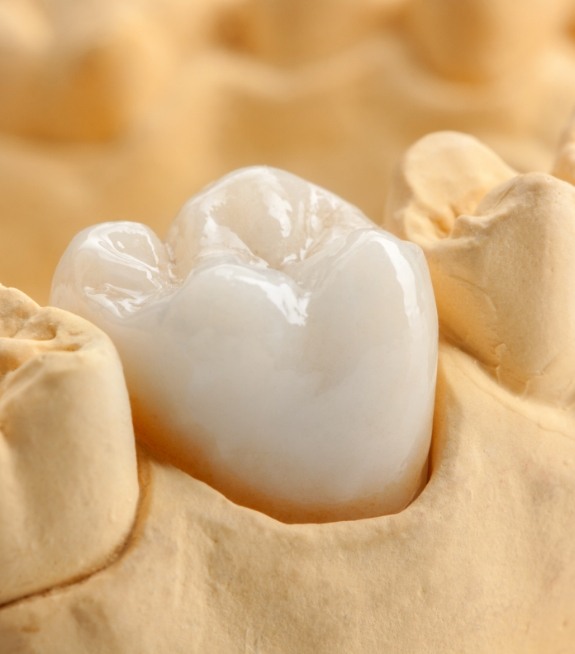 Dental crown covering a tooth in a model of the mouth