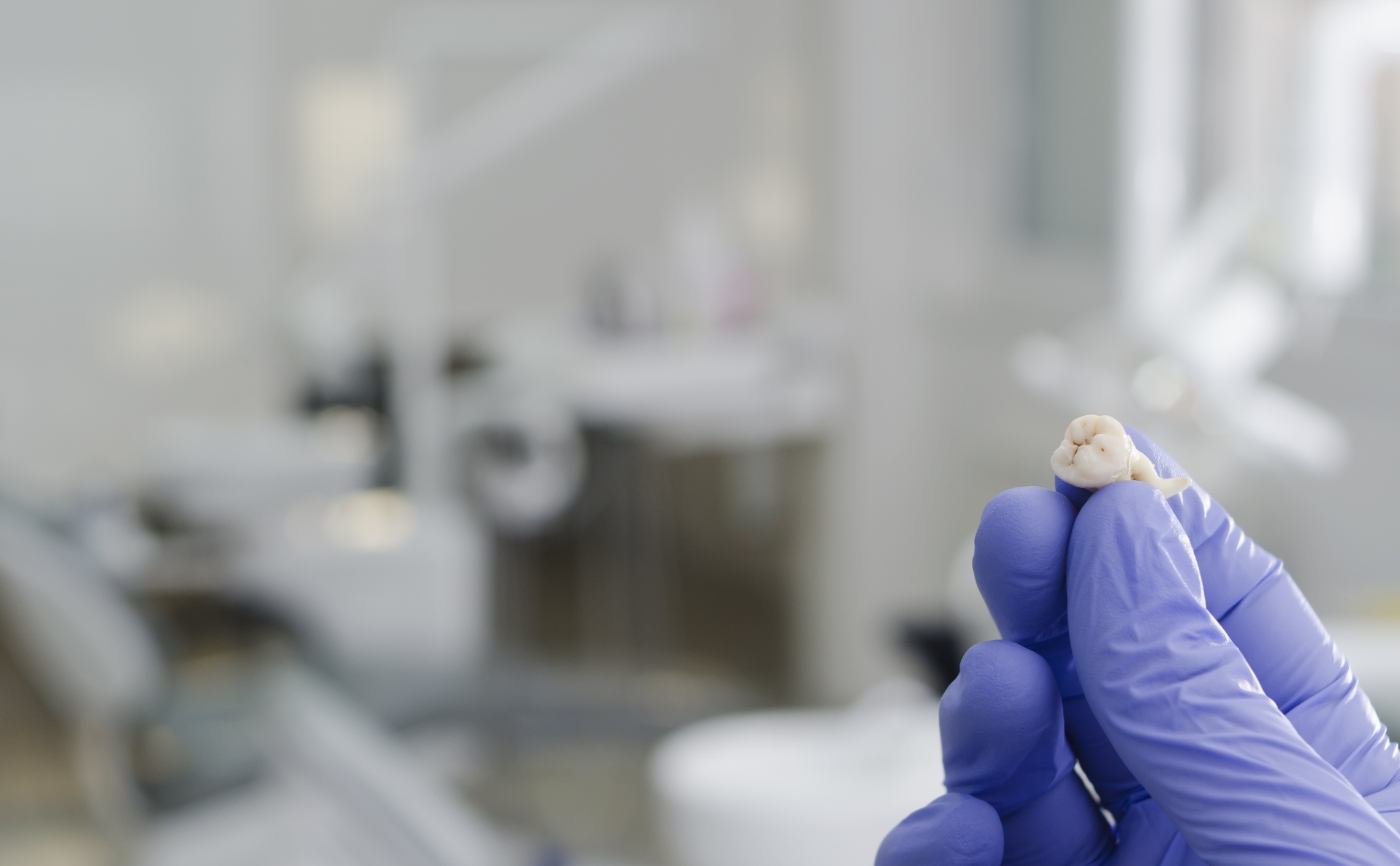 Gloved hand holding an extracted tooth