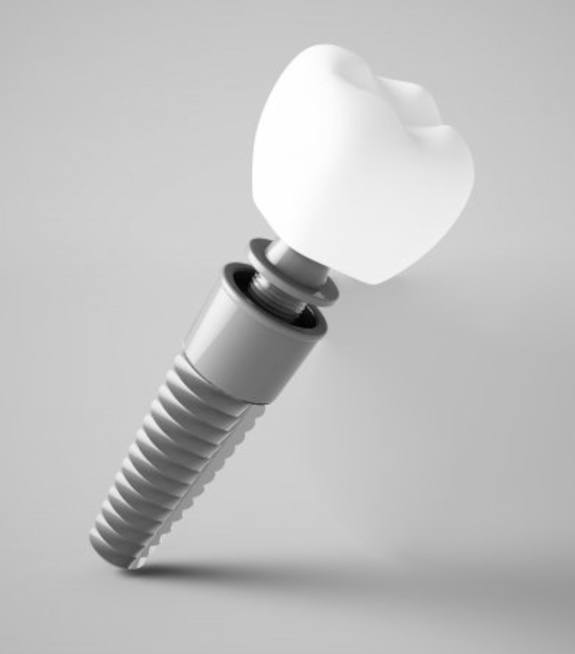 Picture of a dental implant