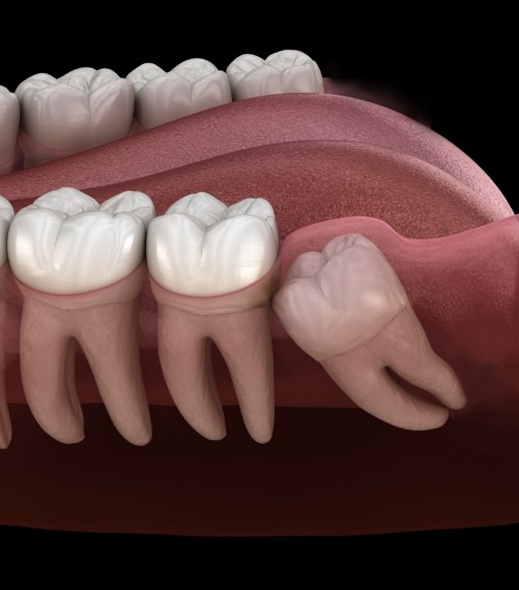 Illustration of impacted wisdom tooth pressing against adjacent molar